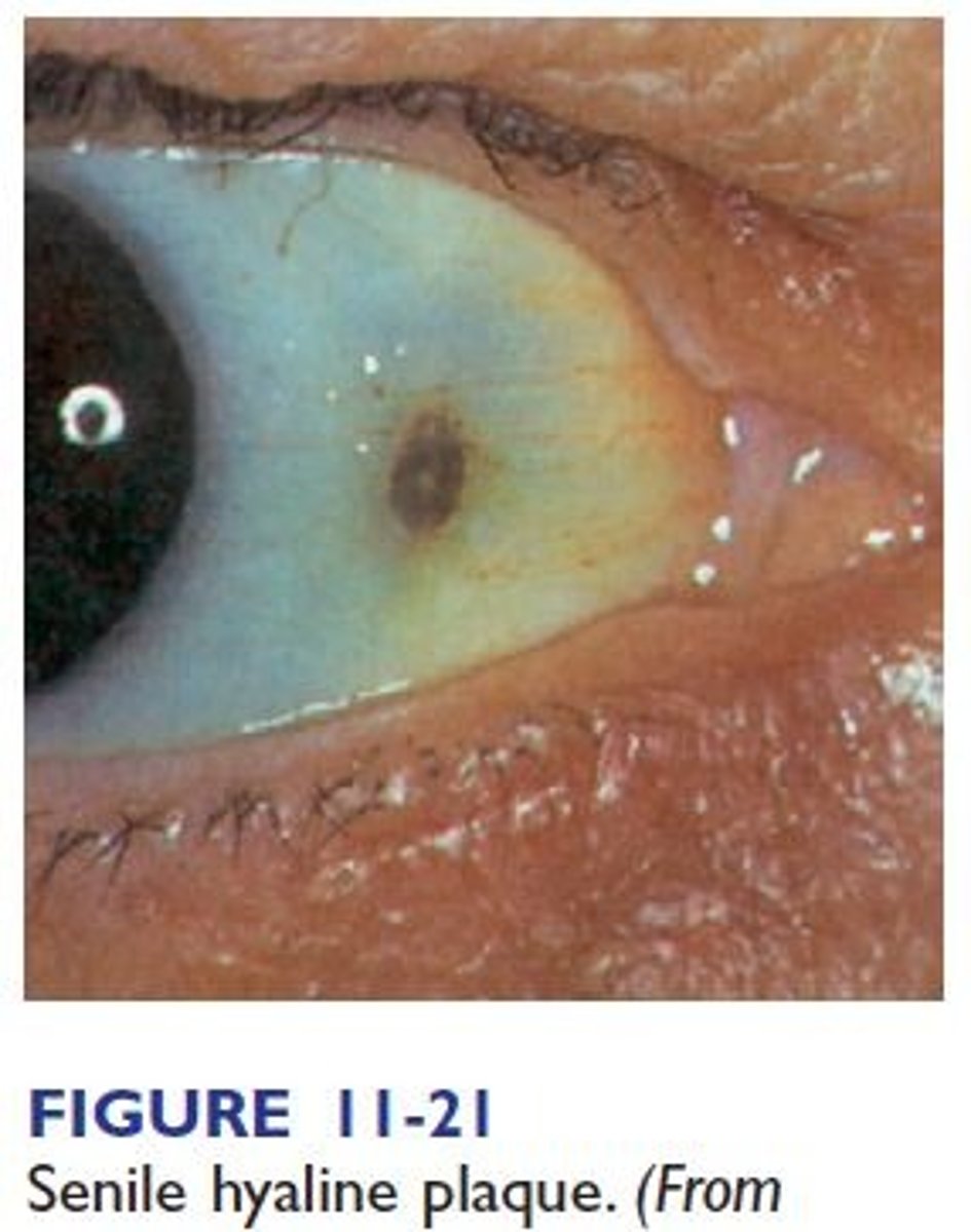 <p>False; doesn't require intervention, just a gray pigmented area anterior to the insertion of the medial rectus muscle</p>