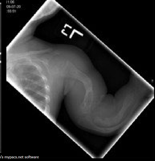 <p>Hereditary brittle bone disease due to collagen deficiency.</p>