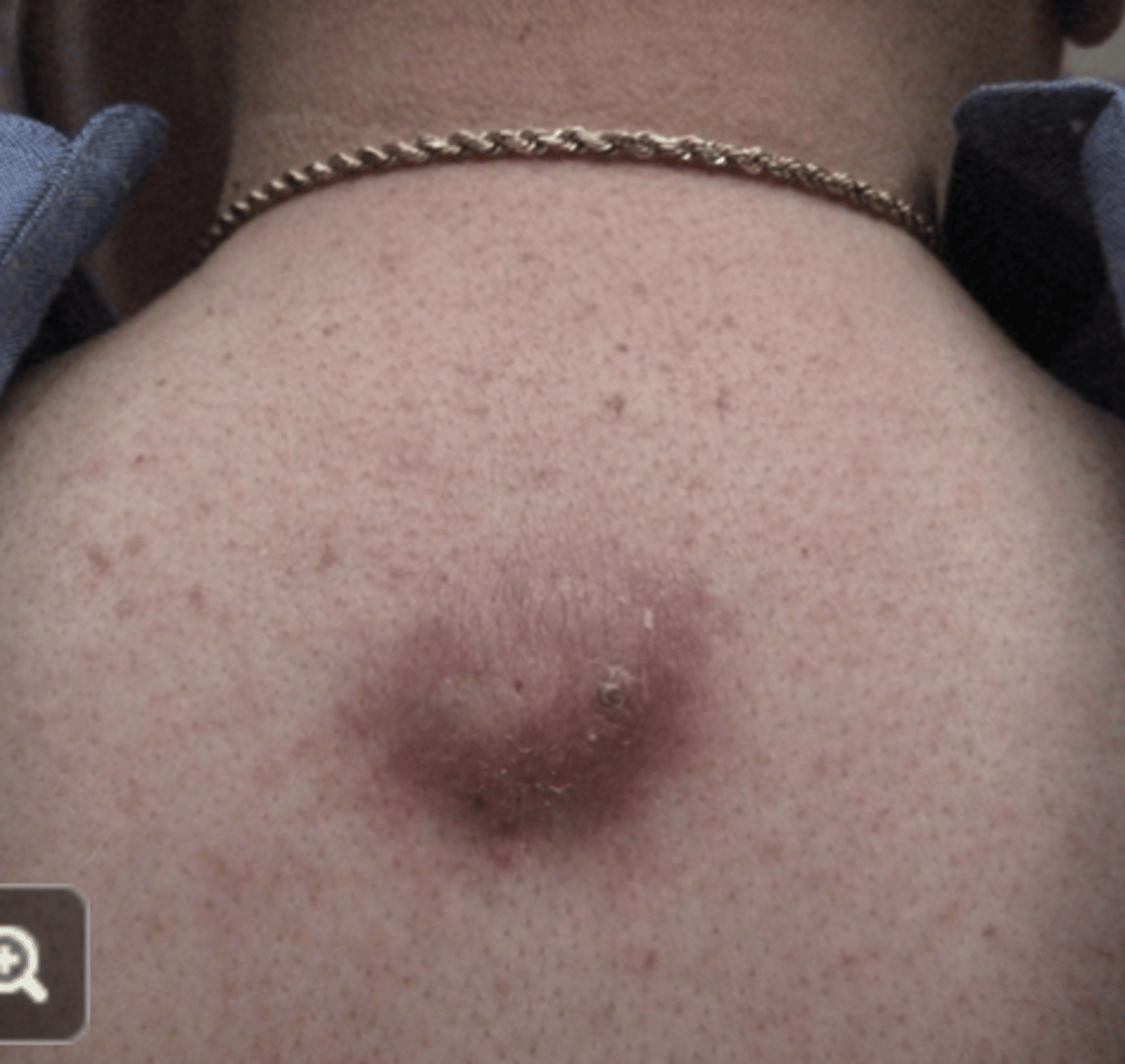 <p>What is contained within epidermal inclusion cysts?</p>