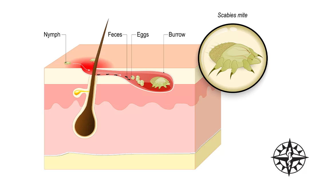 <p>PP: female mites burrow into skin+lay eggs</p><p><u>eruption conditions:</u></p><ul><li><p>length of infestation</p></li><li><p>climate</p></li><li><p>host’s immune status</p></li></ul><p>E: sarcoptes scabiei mites<br>personal contact<br>contaminated linens+clothing</p><p>CM: pruruitic papular lesions<br>excoriations<br>s-shaped burrows</p><p><u>common sites:</u></p><ul><li><p>finger webs</p></li><li><p>wrists</p></li><li><p>axillae</p></li><li><p>lower abdomen</p></li><li><p>genitals</p></li><li><p>buttocks</p></li></ul><p><strong>adults: scalp</strong><br><strong>face</strong></p><p><strong>infants: entire body</strong></p><p>DX: surgical blade→scrape burrow→place on slide+mineral oil→examine under microscope</p><p>TX:<br>NP: clothing+bed lines changed+laundered thoroughly</p><p>MX:<br><u>topical permethrin 5% cream</u></p><ul><li><p>neck to feet</p></li><li><p>wash over 8-10 hours later</p></li><li><p>repeat x 1 week</p></li></ul><p><u>PO ivermectin</u></p><ul><li><p>take on day 1</p></li><li><p>repeat x 1 week</p></li></ul><p></p>