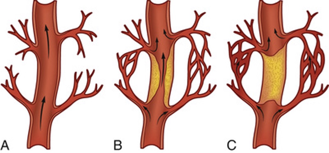 <p>ways to bypass clot and get to other side → still able to perfuse </p><ul><li><p>can happen when fatty plaque happens over time </p></li><li><p>woman in menopause can have plaque build up quickly → this doesn’t happen </p></li></ul><p></p>
