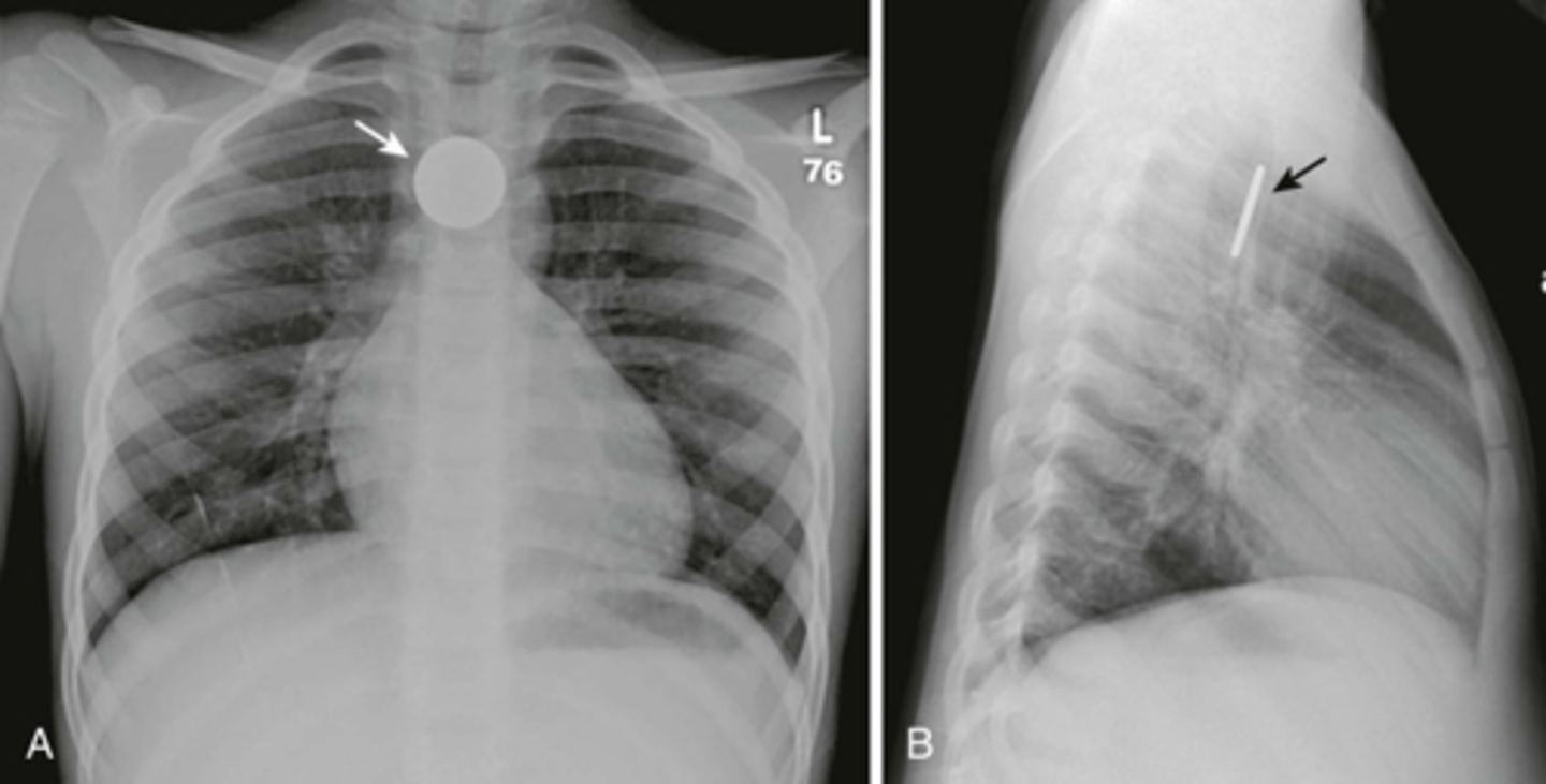 <p>Cricopharyngeus muscle; drooling &amp; feeding intolerance, esp. in young kids</p>