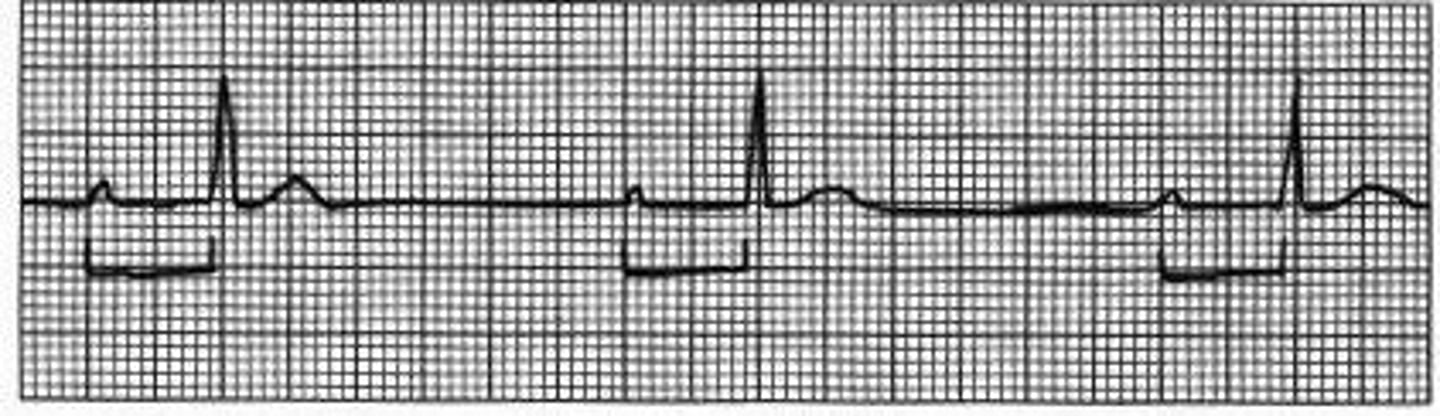 <p>Prolonged PR interval, always a QRS following the p wave</p>