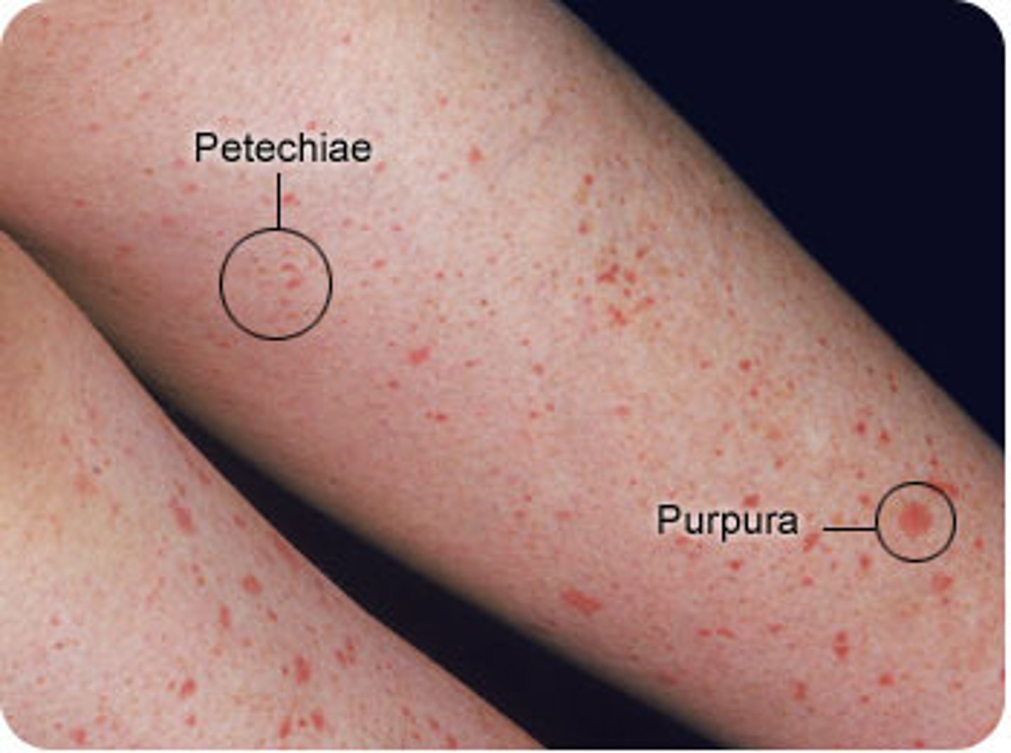 <p>small, pinpoint hemorrhages (1-2mm diameter)</p><p>due to thrombocytopenia, clotting factor deficiency or increased pressure in capillaries.</p>