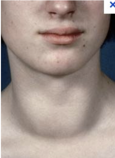 <p>Hashimoto disease</p>
