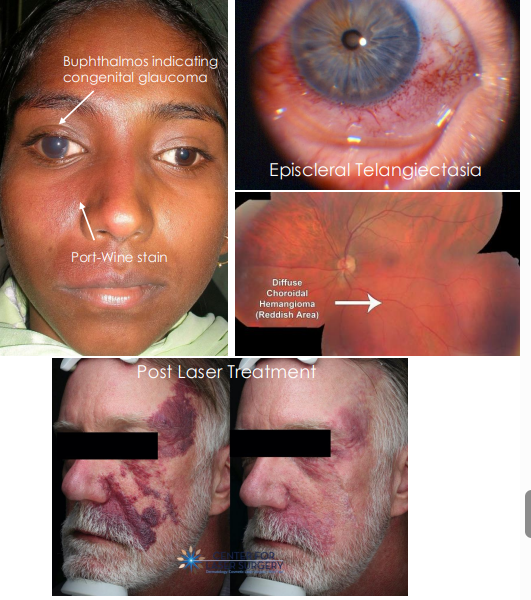 <ol><li><p><strong><u>Red to purple lesions</u></strong> around eyelids and periorbital region</p></li><li><p>• Often <strong><u>Unilateral but sometimes crosses midline</u></strong></p></li><li><p>• Flat at birth but can become nodular with age</p></li><li><p>• <strong><u>Growth parallels growth of individual</u></strong></p></li><li><p>• Follows the CN 5 (Trigeminal nerve) distribution</p></li><li><p>• <strong><u>Sturge-Weber Syndrome (SWS)</u></strong></p><ol><li><p>• Neurocutaneous disorder with abnormal blood vessel growth in brain, skin and eye</p></li><li><p>•<strong><u> Ocular complications:</u></strong></p><ol><li><p><strong><u>• Episcleral telangiectasia, Congenital glaucoma, Choroidal hemangioma and retinal detachment</u></strong></p></li><li><p><strong><u>• Upper eyelid involvement highly associated with glaucoma</u></strong></p></li></ol></li></ol></li></ol><p></p>