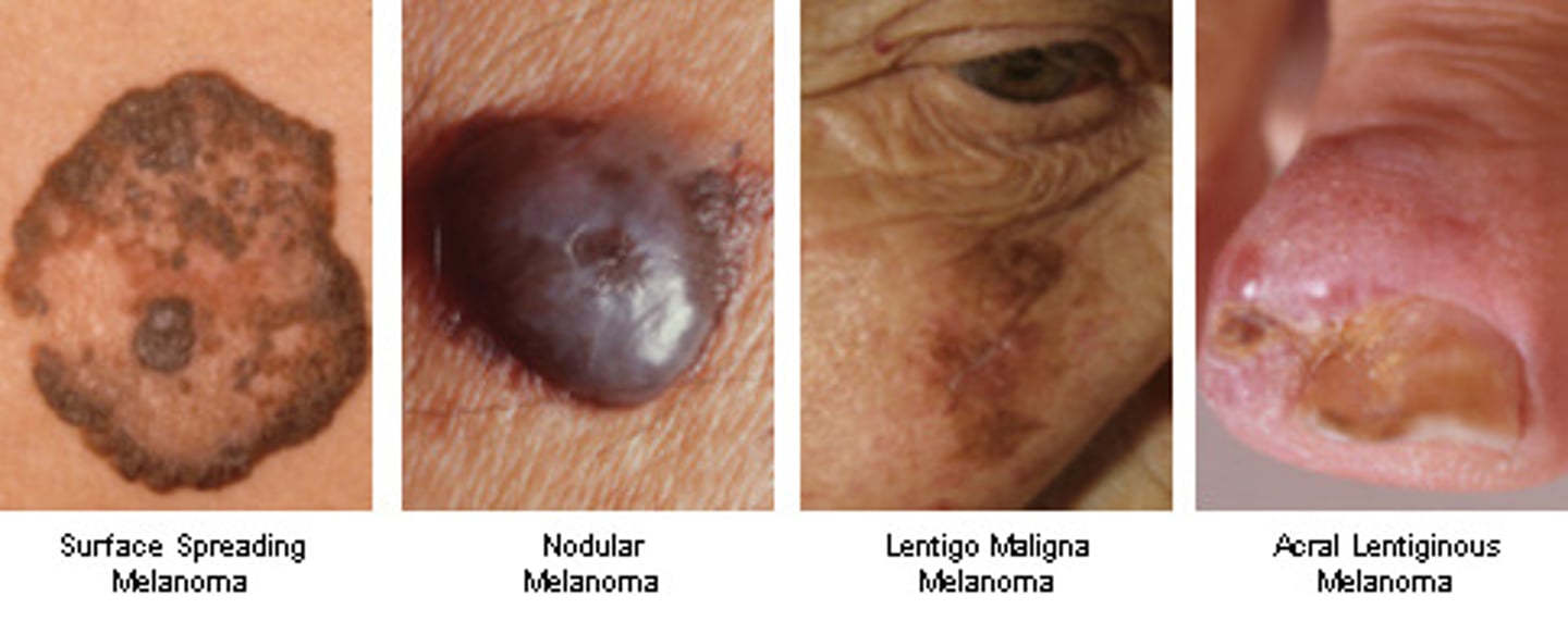 <p>Melanoma</p>