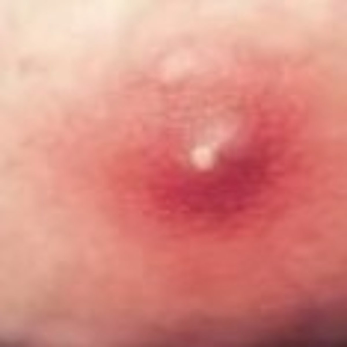 <p>boil (furuncle)</p>