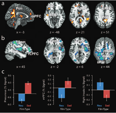 <p>Compared brain activity during sad vs neutral clips and shows which brain areas are more or less active during sadness compared to neutral processing for the control group. </p><p>A = areas with more BOLD signal for sad compared to neutral (activation)</p><p>B = areas with less BOLD signal for sad compared to neutral (deactivation) </p><p>C = compares neutral and sad in terms of activation (1/2 = more active, 3 = less active for sad)</p>