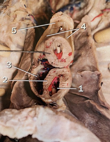 2? (division between two ventricles)