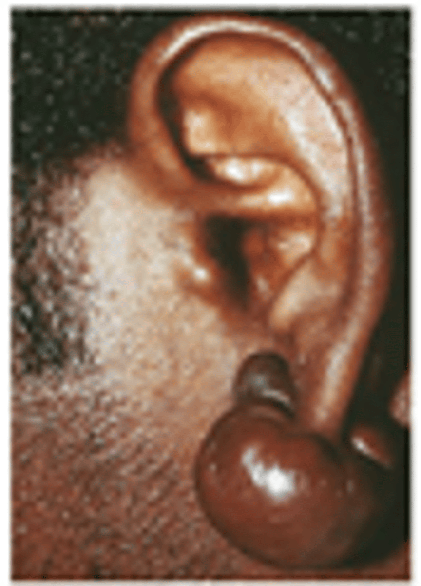 <p>- Skin type (darker pigment --> prominent scar)</p><p>- Keloid/Hypertrophic tendency </p><p>- Suture Tension</p><p>- Stitch Abscess</p><p>- Duration of sutures</p>