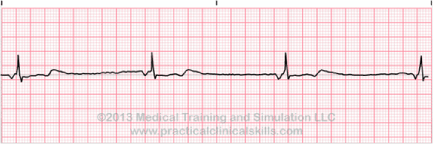 <p>Which Arrythmia is this?</p>