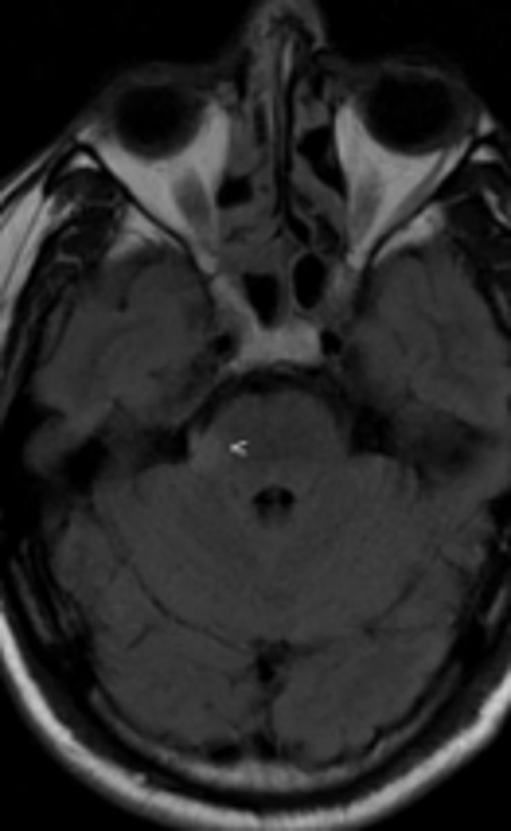 <p>MRI sequence that highlights locations of water.</p>