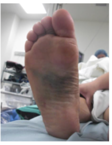 <p>What might you find on physical exam of a Lisfranc fractures</p>