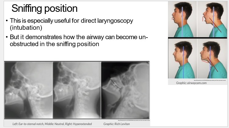   

•This is especially useful for direct laryngoscopy  (intubation)

  

•But it demonstrates how the airway can become un-  obstructed in the sniffing position

  