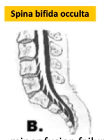 <p>Spina bifida occulta</p>