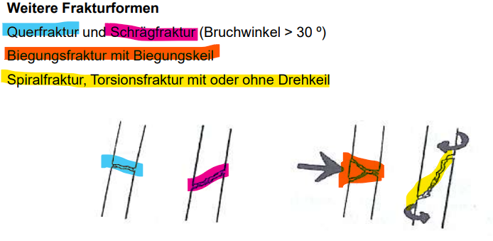 <p>Heilkompetenz: Querfrakturen sind schwerer einzuschätzen als der Rest</p>