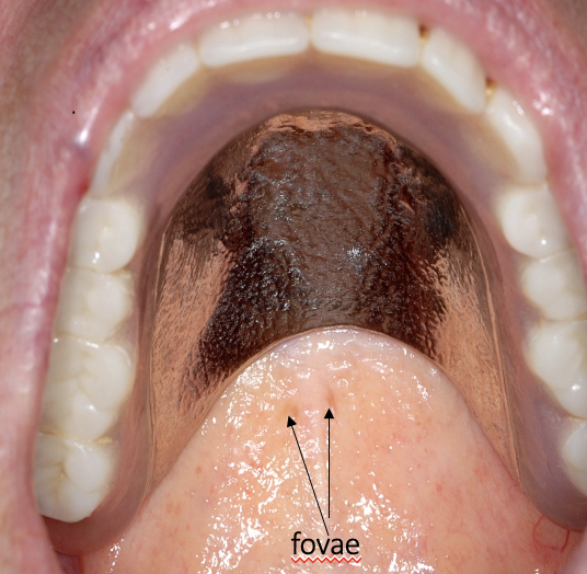 <p>describe the placement of these dentures </p>