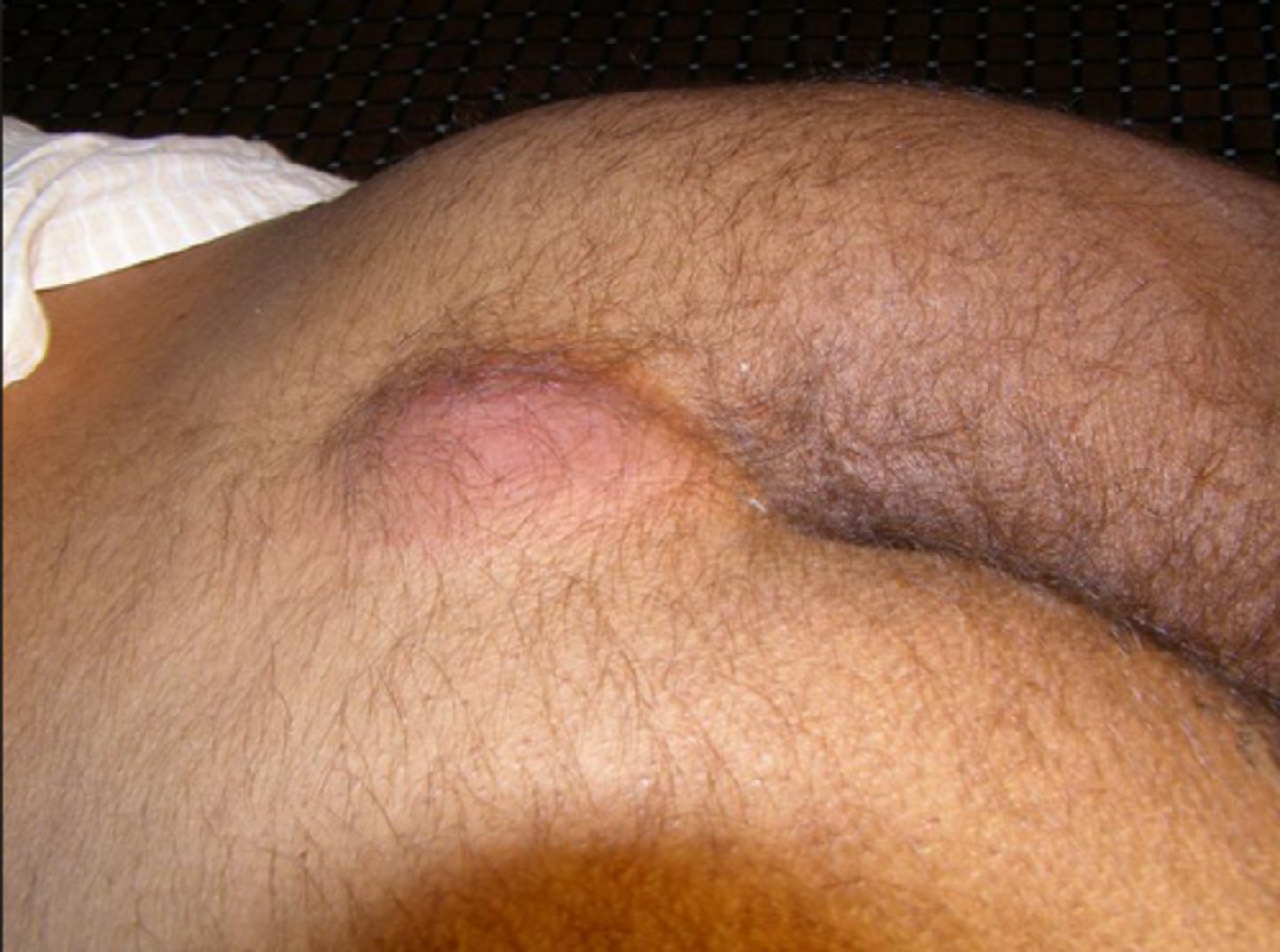 <p>Abnormal pocket of skin that usually contains hair and skin debris</p><p>Located near the tailbone at the superior gluteal cleft</p><p>Usually occurs when hair punctures the skin and then becomes embedded</p>