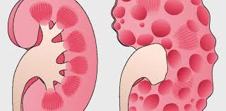 <p><strong>One of the most reliable predictors for worsening autosomal dominant polycystic kidney disease is</strong></p><p>A) serum creatinine levels.</p><p>B) blood urea nitrogen (BUN) level.</p><p>C) urine albumin excretion (UAE).</p><p>D) urine specific gravity. </p>