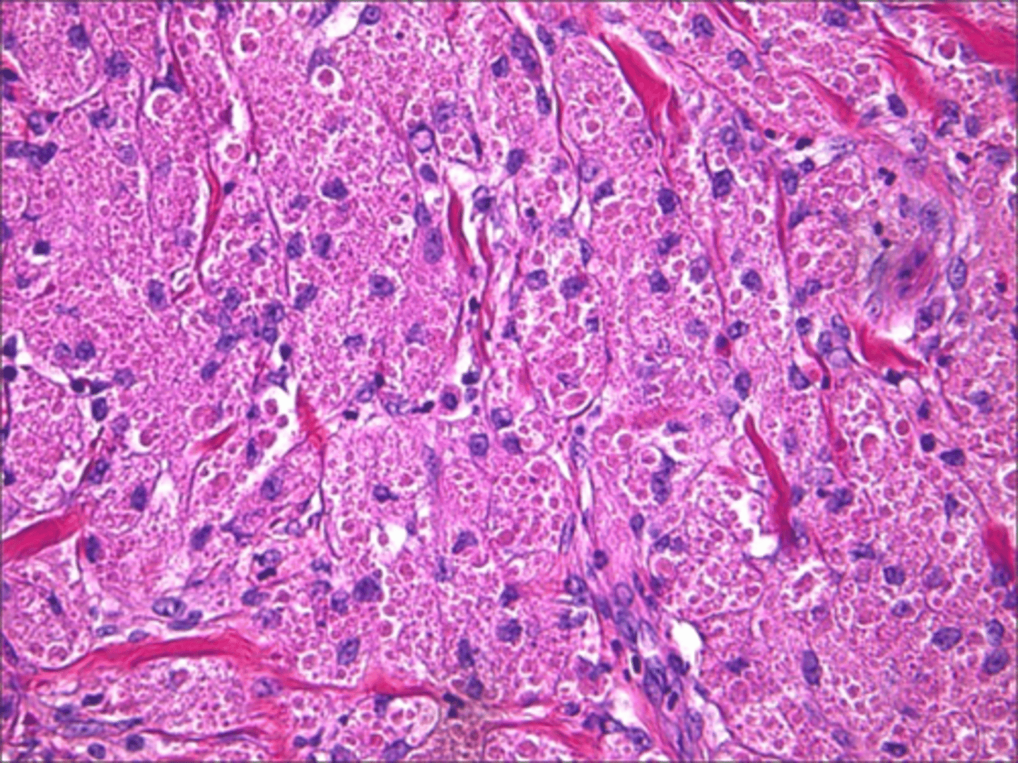 <p>Abundant pale, eosinophilic granular cytoplasm and pseudoepitheliomatous hyperplasia is associated with what pathology?</p>