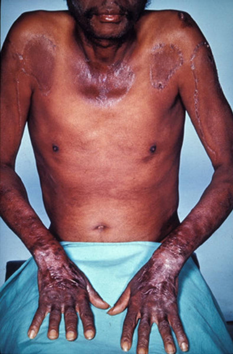 <p>3(4) D's</p><p>1) Dermatitis - sunburn on face, neck & extremities</p><p>2) Dementia - headache, memory loss, confusion, disorientation</p><p>3) Diarrhea - inflammation of mucus membrane of mouth & GI tract (glossitis, cheilosis, angular stomatitis)</p><p>4) Death</p><p>Additionally mouth issues found in Ariboflavinosis (Cheilosis - cracking of mouth, Angular stomatitis, Glossitis - inflammation of the tongue)</p>