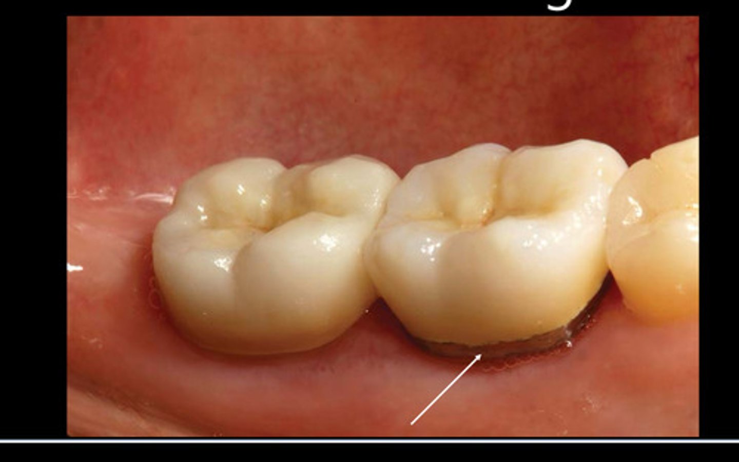 <p>Often on lingual</p>