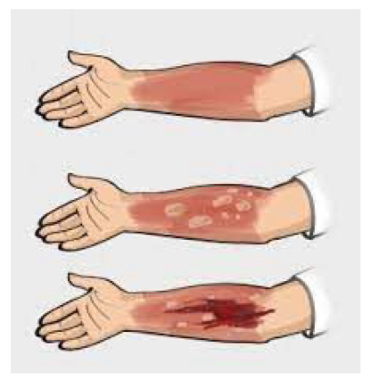 <ul><li><p>extent of body surface area</p><ul><li><p>rule of nines is used to estimate % of the body surface area affected by a burn</p></li></ul></li><li><p>degree of burn</p><ul><li><p>first degree</p></li><li><p>second degree</p></li><li><p>third degree</p></li></ul></li></ul><p></p>
