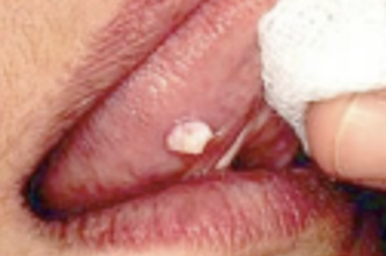<p>Het is een lokaal op de orale mucosa voorkomende epitheelproliferatie en kan overal in de mond voorkomen. Voorkeurslocaties zijn het palatum durum, palatum molle en de uvula. De oorzaak is niet geheel bekend, maar heeft een relatie met het hiv- virus. Klinisch gekenmerkt het papilloom zich door betrekkelijk kleine, gesteelde, grijs/gele afwijkingen met een bloemkoolachtig aspect. De behandeling bestaat uitexcisie, waarbij altijd histopathologisch onderzoek is geïndiceerd. Meestal komt het na verwijdering niet meer terug.</p>