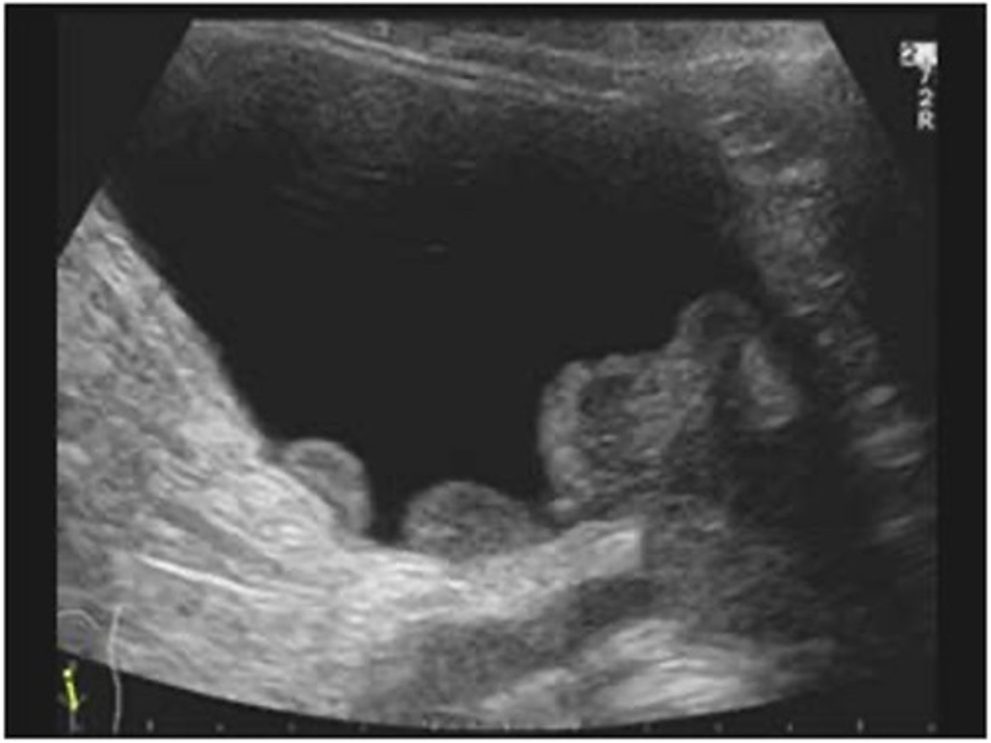 <p>TCC is more common in ___ </p>