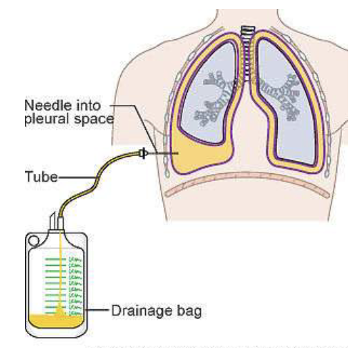 <p>removal of excessive fluid in pleural cavity w/ a needle</p>
