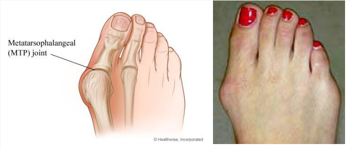 <p>Swelling of metatarsophalangeal (MTP) joint</p><p></p>