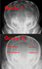 <ul><li><p><strong>Cause:</strong></p><ul><li><p><strong><u>Congenital</u></strong> defect of <strong><u>foramen magnum</u></strong></p><ul><li><p><strong>young Dome head toy breeds</strong></p></li></ul></li></ul></li><li><p><strong>CS:</strong></p><ul><li><p><strong>cervical pain</strong>, <strong>hind limb neurologic deficits</strong></p></li></ul></li><li><p><strong>Views:</strong></p><ul><li><p>Lateral, closed mouth VD, slight obliqued VD</p></li><li><p><u>Needs MRI/CT scans</u></p></li></ul></li><li><p><strong>RS:</strong></p><ul><li><p><strong><u>Abnormal foramen magnum with open dorsal extension</u></strong></p><ul><li><p><strong>“keyhole” shape</strong></p></li><li><p>herniation possible</p></li></ul></li></ul></li></ul><p></p>