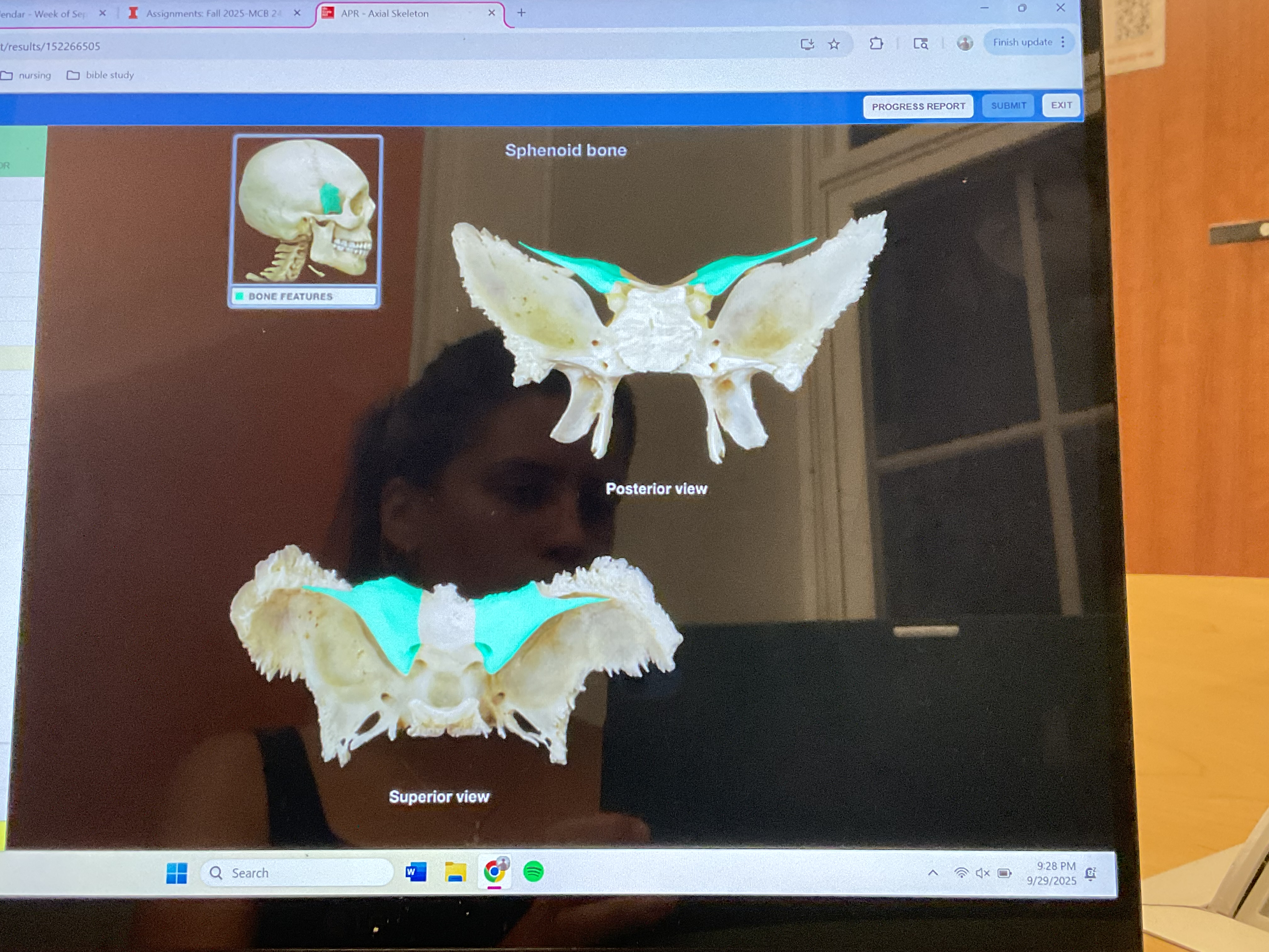 <p>Lesser wing of sphenoid bone</p>