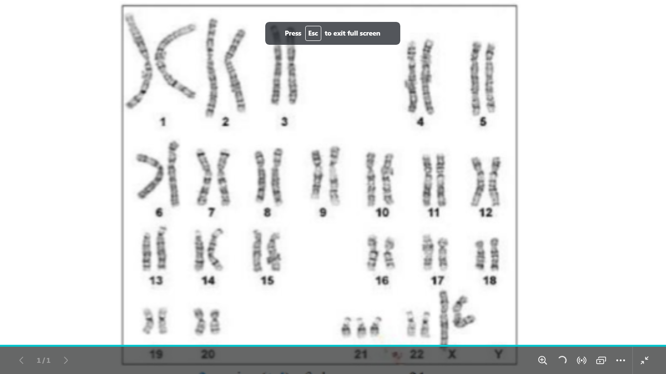 <p>type of chromosomal abnormality</p><p>and write it</p><p>and what is its name</p>