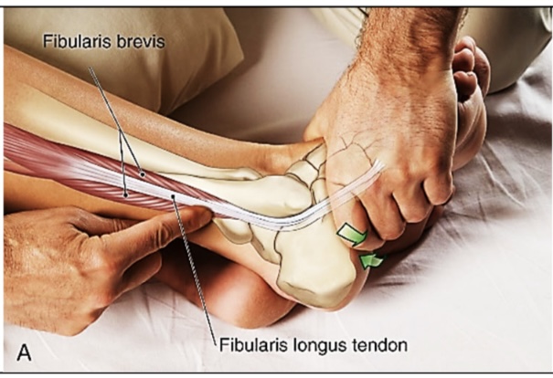 <p>peroneus brevis</p>