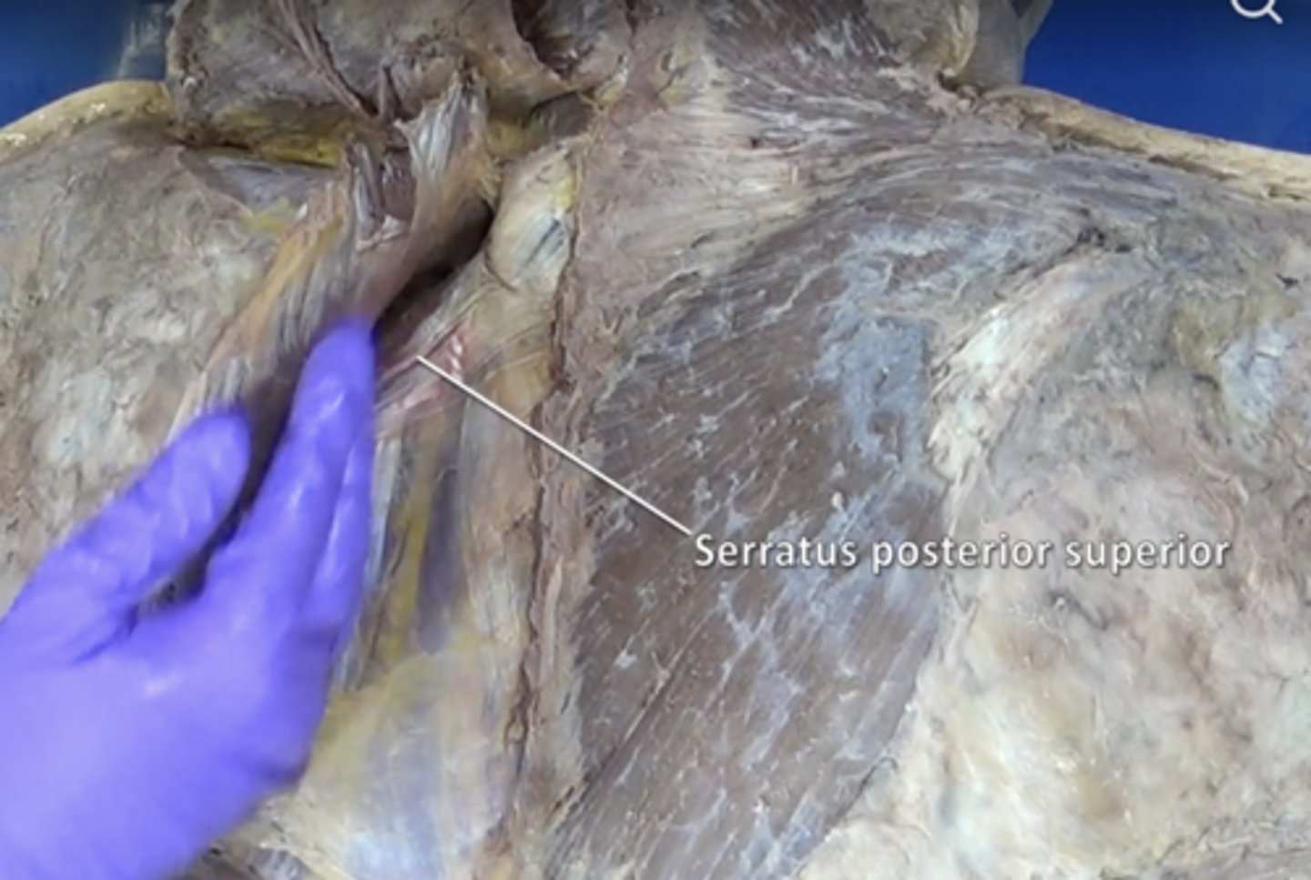 <p>muscle at the top of the back that elevates ribs 2-5</p>