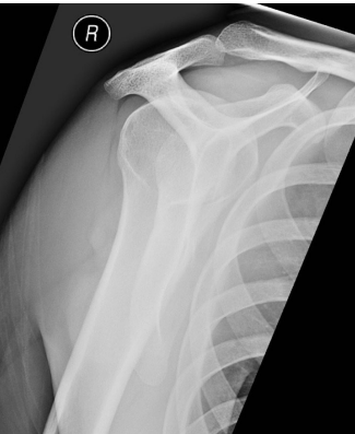<p><strong>Scapular Y View</strong></p><p>-__________ head should sit in the _______ of the Y</p><p>-Shows the profile of the acromion, as well as dislocations </p>