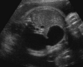 <p>The sonographer scanned a fetus that has Trisomy 21. This was seen.</p><ol><li><p>What US finding is seen here?</p></li><li><p>What pathology is it seen with?</p></li></ol><p></p>