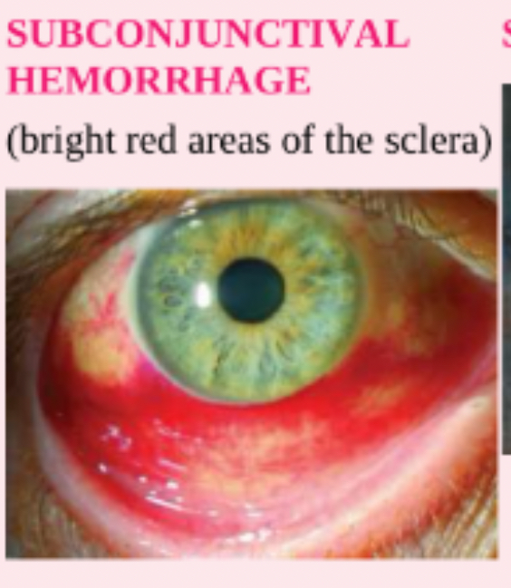<p>subconjunctival hemorrhage </p>