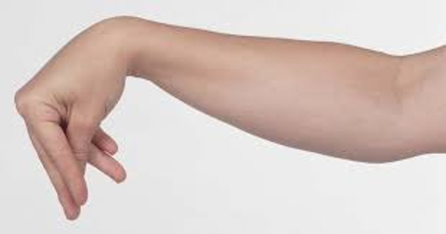 <p>Spasmodic contractions caused by pressing the nerve supplying a muscle; seen in tetany</p>