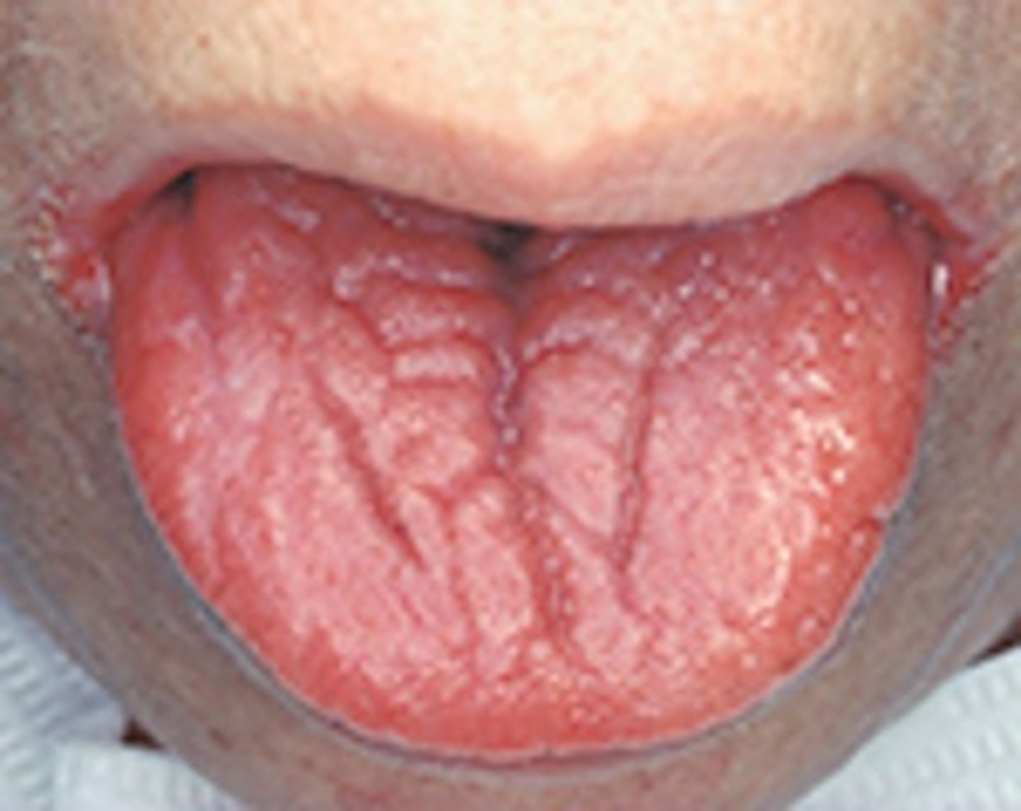 <p>anemia resulting when there is not enough iron to build hemoglobin for red blood cells</p>