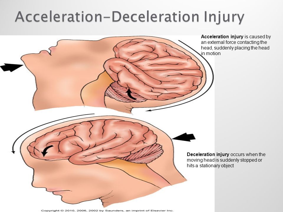 <p>rapid loss of velocity —> when the body stops suddenly, organs continue moving at the original velocity until they either:</p><p>1) hit something or,</p><p>2) tear away from whatever was holding<span>/</span>anchoring them</p>