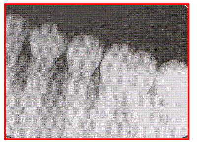 <ul><li><p>Occlusal plane appears tipped or tilted on a radiograph because the edge of the film was not placed PARALLEL to the incisal-occlusal surface of the teeth </p><ul><li><p>Reason: Incorrect film placement → occurs when using digital method (folding film w fingers), and if client fails to close their mouth. </p></li></ul></li><li><p>Fix: Client needs to hold film firmly against tooth to prevent film from dropping or slipping </p></li></ul><p></p>