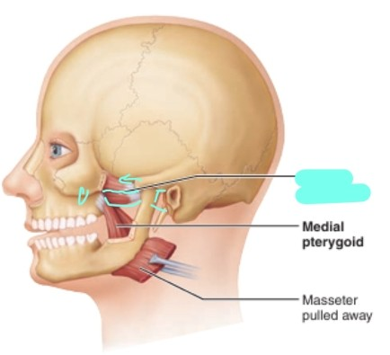 <p>lateral pterygoid muscle</p>