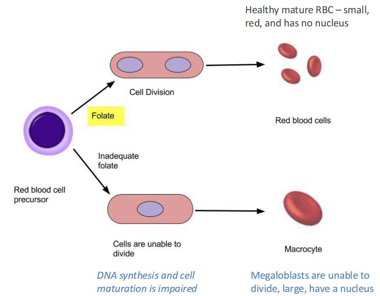 <p>Lead to Megaloblastic macrocytic anemia(lack of O<sub>2</sub>)</p><ul><li><p>Fatigue, weakness, headaches, pallor, SOB</p></li></ul><p></p>