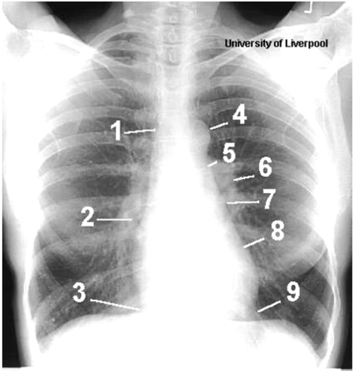<p>1- superior vena cava</p><p>2- right atrium</p><p>3- inferior vena cava</p><p>4- aortic arch or knob</p><p>5- left pulmonary trunk</p><p>6- left pulmonary artery</p><p>7- left atrium</p><p>8- left ventricle</p><p>9- left cardiophrenic angle</p>