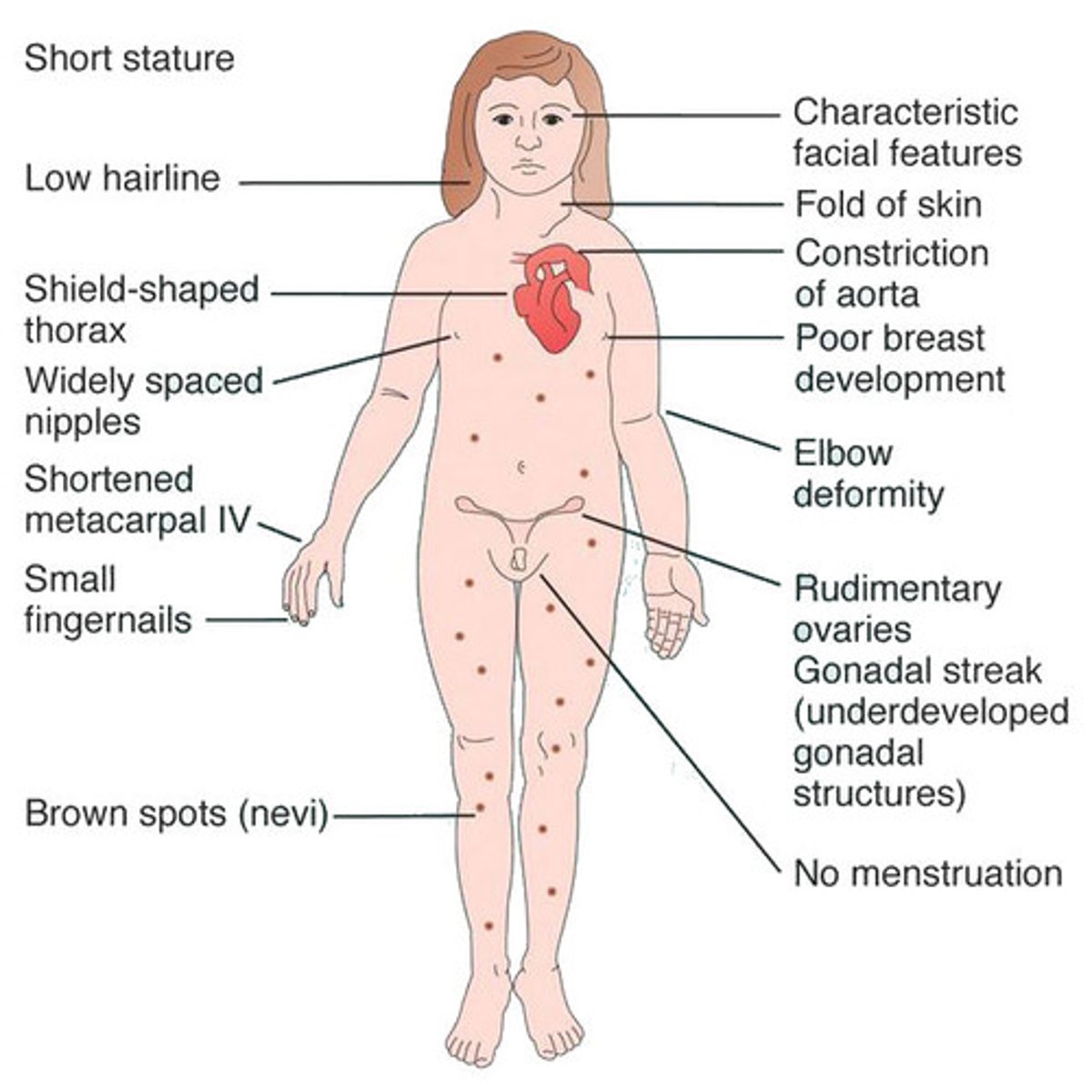 <p>Turners syndrome</p>