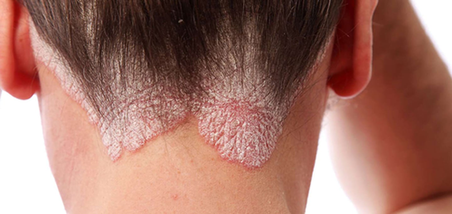 <p>Normal skin cells grow too fast. Appears as white scales that cannot be shed). No cure</p>