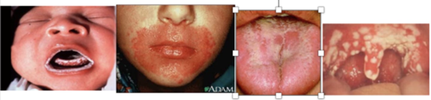 <p><strong>Acute pseudomembranous candidiasis</strong></p><p>•Aka “thrush”</p><p>•<strong>White plaques</strong> on buccal mucosa, palate, tongue, oropharynx</p><p>--Wipe off leaves a red, raw painful surface --&gt; Make Hyphae which dig into the skin</p><p><span style="text-decoration:underline">•Can progress to esophagitis in AIDS pts</span></p><p></p><p>Neonates often get</p>